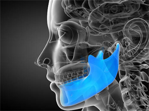 下颌角整形示意图