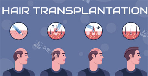 植发过程图 植发过程图