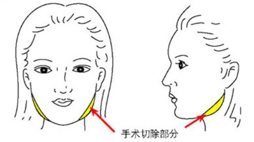 下颌角整形示意图