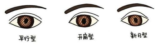 不同类型的双眼皮 不同类型的双眼皮