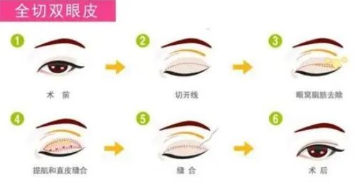 全切双眼皮示意图 全切双眼皮示意图