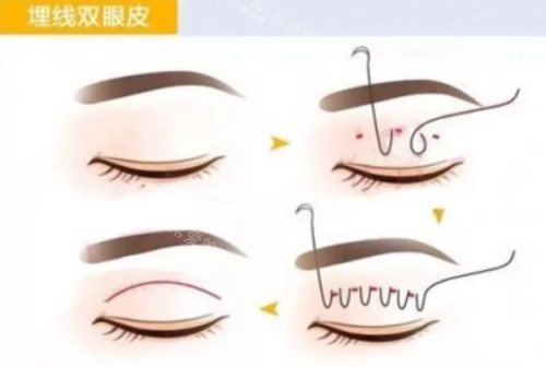 埋线双眼皮示意图 埋线双眼皮示意图