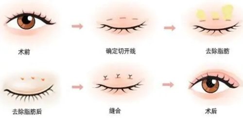 双眼皮手术过程图 双眼皮手术过程图