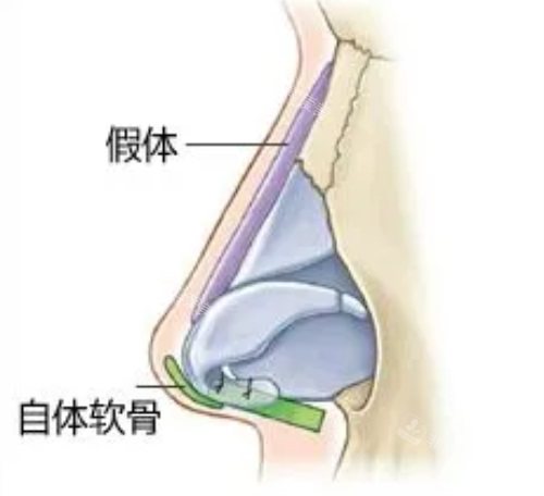 假體軟骨隆鼻示意圖