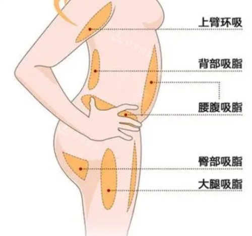 身體各部位吸脂示意圖 身體各部位吸脂示意圖