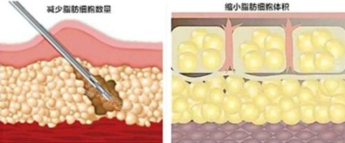 吸脂脂肪細(xì)胞的變化圖 吸脂脂肪細(xì)胞的變化圖