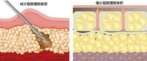 吸脂脂肪细胞的变化图