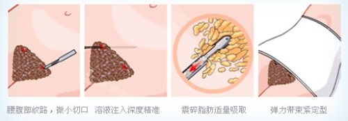 腰腹吸脂示意图