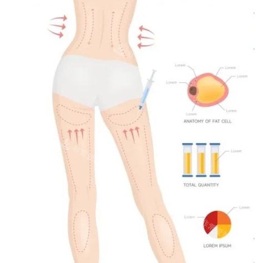 腰腹大腿吸脂示意图