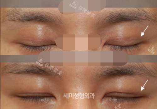 韩国世美整形医院男性眼部修复闭眼示意图