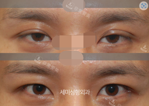韩国世美整形医院男性眼部修复