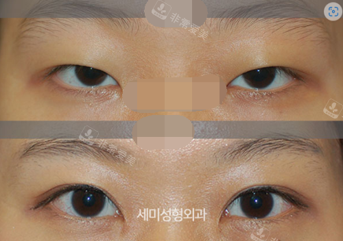 韩国世美整形医院女性眼部修复