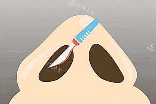 鼻部手术卡通图 鼻部手术卡通图