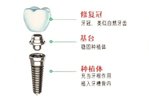 种植牙图示