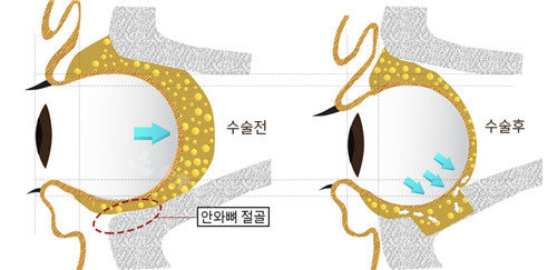 韩国突眼矫正医院排名中必当归医院突眼矫正凹眼矫正出名!