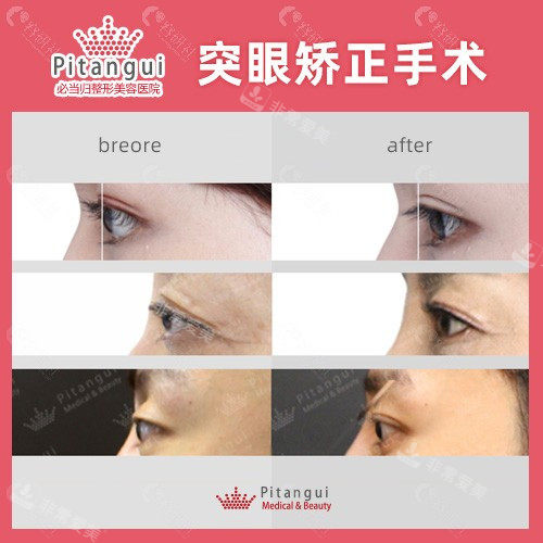 必當(dāng)歸整形外科突眼矯正前后對比照 必當(dāng)歸整形外科突眼矯正前后對比照