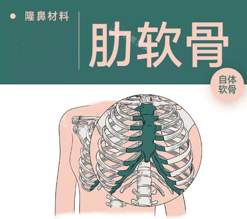 肋軟骨隆鼻材料