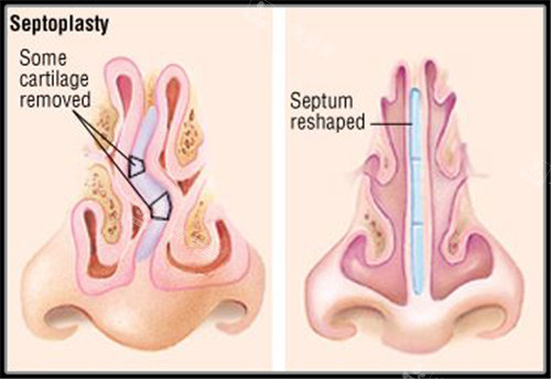鼻中隔弯曲矫正手术原理
