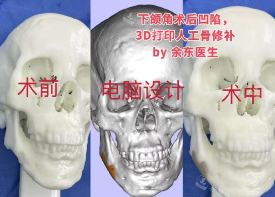 余东医生下颌角补骨手术展示图