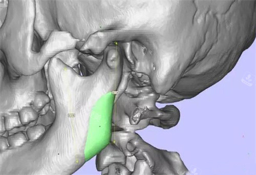 下颌角补骨手术演示图