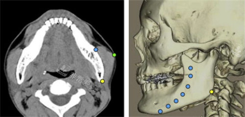 轮廓磨骨CT图示意图