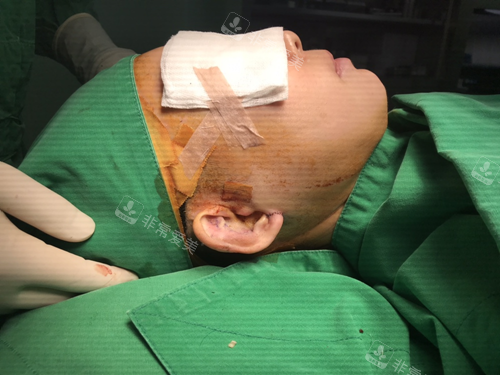 韩国普罗菲耳整形外科医院贴发耳手术中