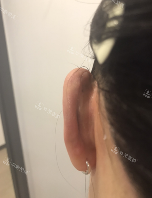 韩国普罗菲耳整形外科医院贴发耳手术术后疤痕