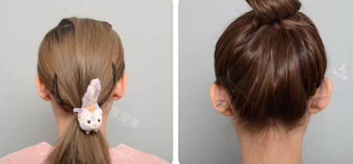 韩国普罗菲耳整形外科医院贴发耳矫正前后对比
