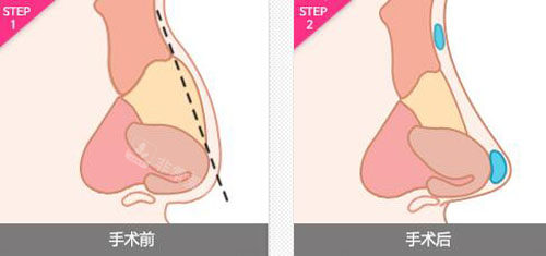 韓國(guó)NJH盧鐘勛整形隆鼻特點(diǎn)示意圖