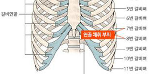 韩国NJH卢钟勋整形肋软骨取出部位展示