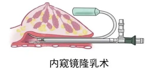 內(nèi)窺鏡隆胸技術(shù) 內(nèi)窺鏡隆胸技術(shù)