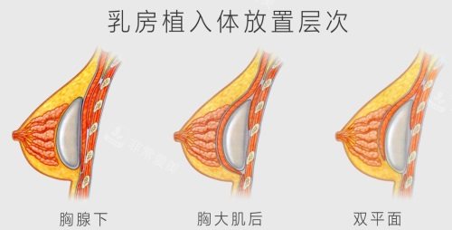假體植入位置示意圖 假體植入位置示意圖