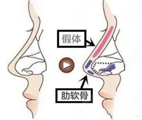 隆鼻方式示意圖