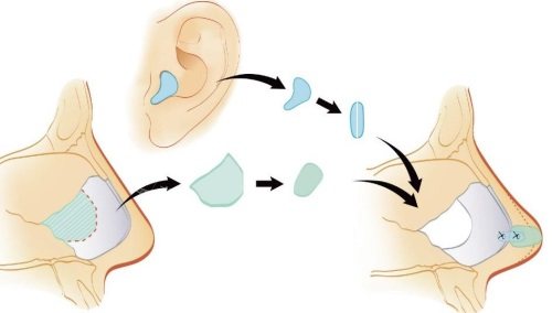 耳软骨隆鼻示意图