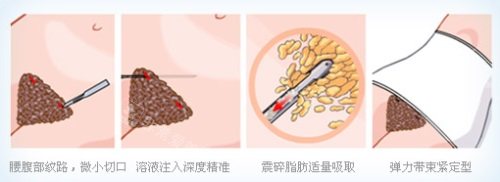 腰腹吸脂示意圖 腰腹吸脂示意圖