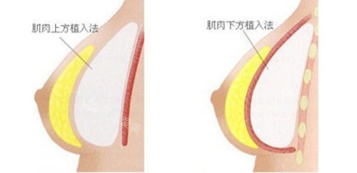 假体植入方法示意图