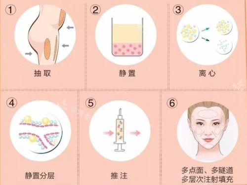 脂肪填充過程圖 脂肪填充過程圖