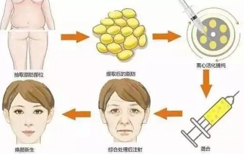 脂肪填充示意圖 脂肪填充示意圖