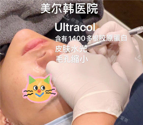 美尔韩方医院ULTRACOL注射图示 美尔韩方医院ULTRACOL注射图示