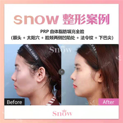 韓國SNOW整形外科全臉脂肪填充變化圖