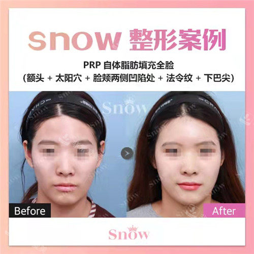 韩国SNOW整形外科全脸脂肪填充前后图