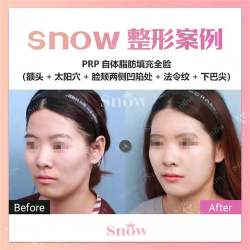 韓國SNOW整形外科全臉脂肪填充對比照