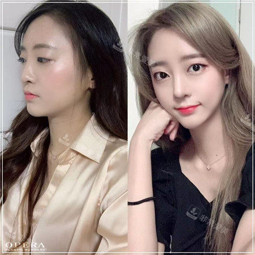 韓國歐佩拉OPERA整形外科輪廓整形對比 韓國歐佩拉OPERA整形外科輪廓整形對比