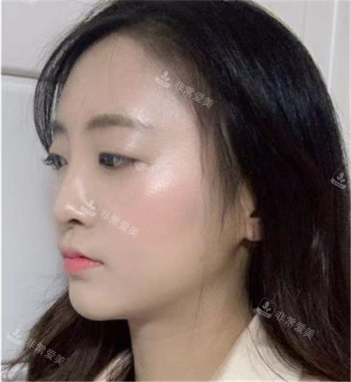 韓國歐佩拉OPERA整形外科輪廓整形術(shù)前圖 韓國歐佩拉OPERA整形外科輪廓整形術(shù)前圖