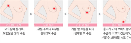 韩国伊美芝整形隆胸方法图