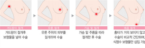 韩国伊美芝整形隆胸怎么样，金成南专注打造自然弧度美胸