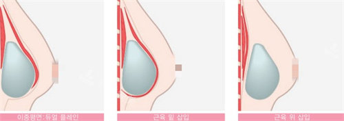 韩国伊美芝整形假体放置位置图