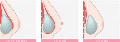 韓國伊美芝整形假體放置位置圖 韓國伊美芝整形假體放置位置圖