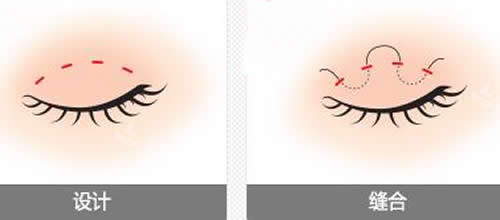 韩国NJH卢钟勋整形做双眼皮手术特点分享，眼整形受欢迎！