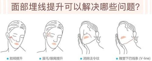 埋線提升的優(yōu)點 埋線提升的優(yōu)點